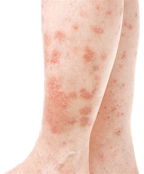 Psoriasis Leg Stock Photos Pictures And Royalty Free Images Istock