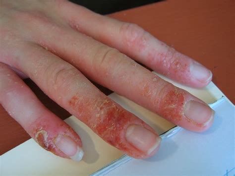 See Pictures Of Eczema Before And After Chinese Herbal Treatment