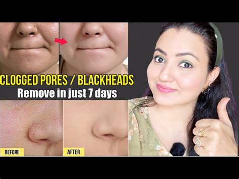 4 Days Challenge Remove Clogged Pores Blackheads And Whiteheads In