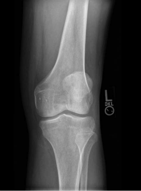 Normal Knee X Ray 3 View Jetem