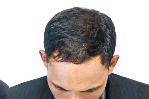 Best Mens Balding Treatment 🧬 Andro Genetic
