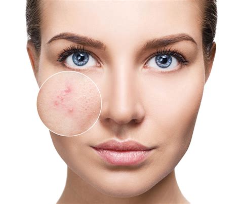 Get Rid Of Acne At Sovereign Skin Laser Clinic In Toronto