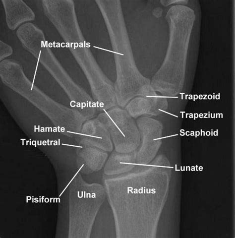 X Ray Image Showing The Left Hand Wrist In Dorsal View