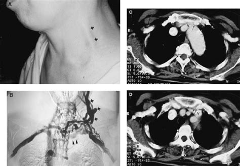 A Unusual Engorgement Of The Left External Jugular Vein Noted After
