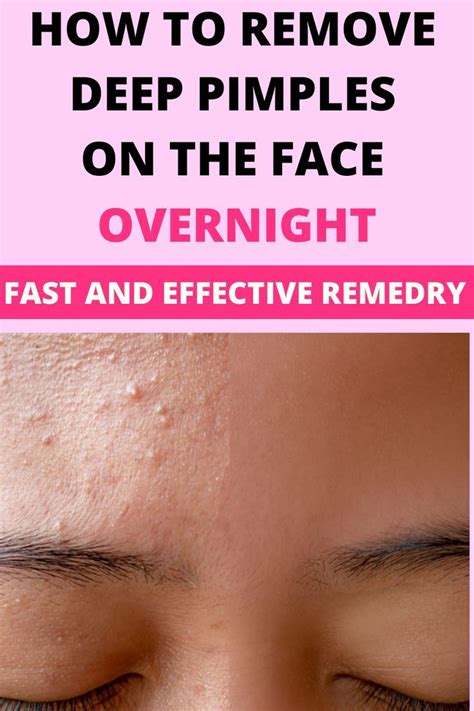 How To Get Rid Of Pimples Overnight 11 Effective Ways Artofit