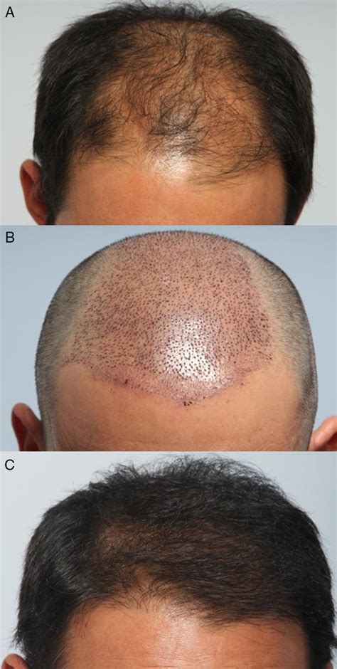 Good Candidate Patient For Either Follicular Unit Extraction Fue Or
