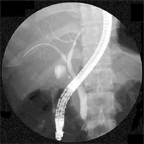 Cholangiogram Showing A Leak Originating At The Duct Of Luschka That