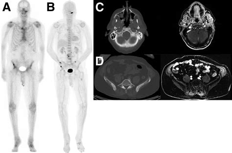 Prospective Comparison Of 99mtc Mdp Scintigraphy Combined 18f Naf And
