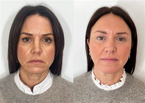 Best Dermal Fillers Near Me In London At The Cosmetic Skin Clinic