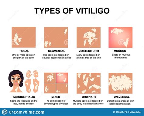 View 10 Types Of Vitiligo Skin Disease Churchreesz