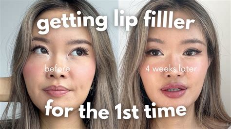 First Time Getting Lip Filler Week Healing Process Vlog Youtube