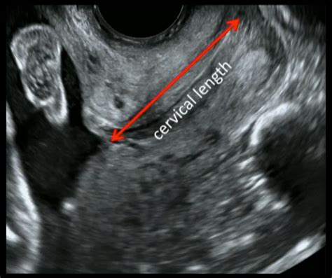 Learn How To Visualize And Measure The Cervix In Pregnant Patients With