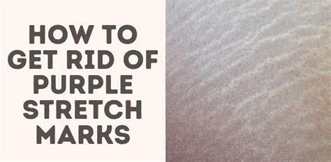 How To Get Rid Of Purple Stretch Marks Treat Your Scars