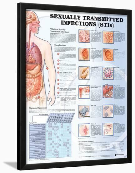 Sexually Transmitted Infections Anatomical Chart Poster Photo