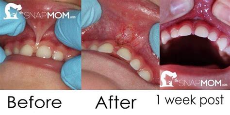 Dentist East Berlin Pa Lip Tie Images Pre And Post Lip Tie Treatment