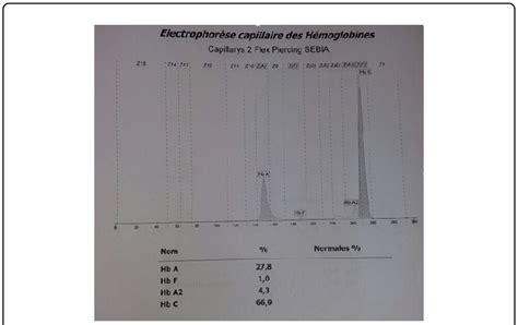 Capillary Electrophoresis Results Of The Mothers Hemoglobin