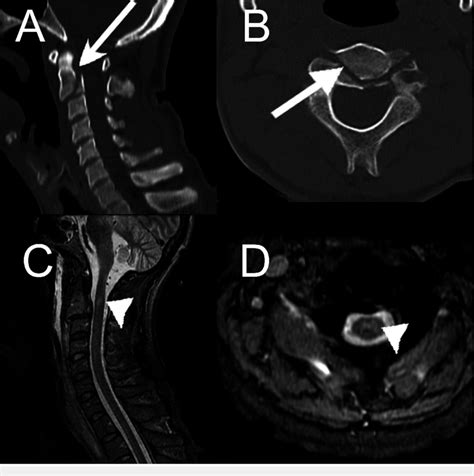 Case 2 Cervical Spine Computed Tomography Ct And Magnetic Resonance