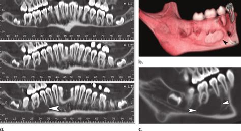 Ct Appearance Of The Teeth A Dental Ct Images Panoramic Or