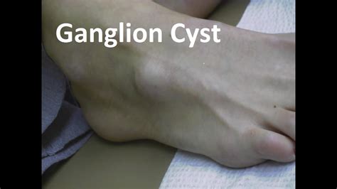 Ganglion Cyst On The Foot Removal Guide Youtube