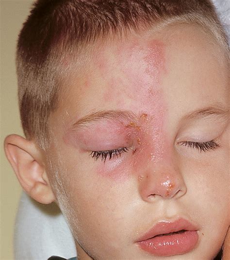 Treatment for hsv 2 can bring about certain side effects. Alternative veterinary medicine houston, herpes treatment ...