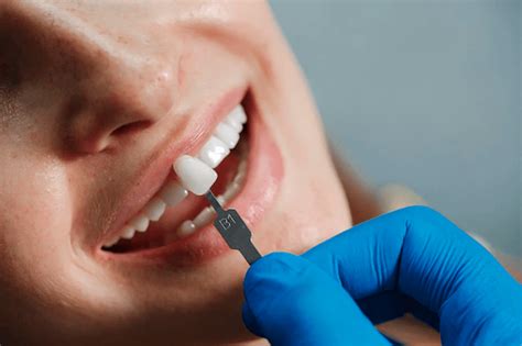 Lente De Contato Dental Tudo Sobre O Procedimento RIZI