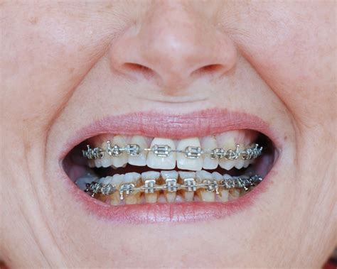 How To Keep Teeth White With Braces Informationwave17