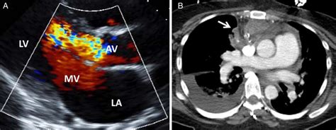 A Echocardiography Demonstrating Severe Aortic Regurgitation B
