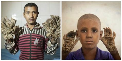 The 12 Year Old Girl Battling With Tree Man Disease That Has Caused