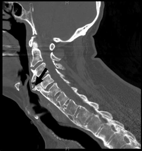 Noncontrast Ct Scan Of The Cervical Spine Revealed A Large