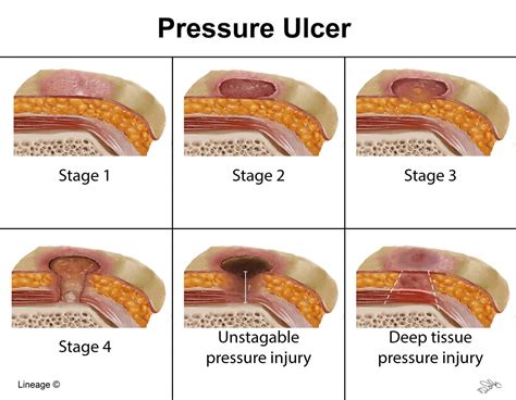 Skin Pressure Ulcer Stages