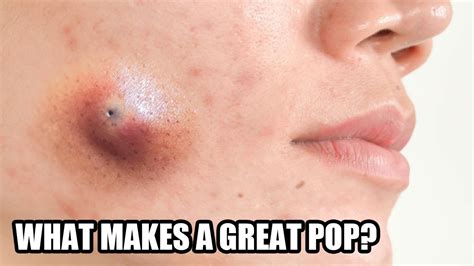 Greatest Cysts What Makes A Great Pimple Pop And Blackhead Youtube