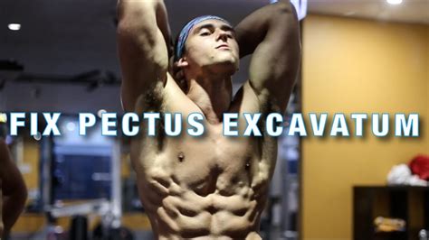 Why Exercise Is So Important To Fix Pectus Excavatum Youtube