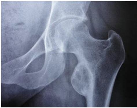 Small trochanter) is a conical eminence, which varies in size in different subjects; Non Traumatic Myositis Ossificans Mimicking a Malignant ...