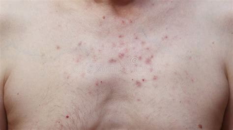 Skin Reaction On A Man Chest After Chemotherapy Allergic Reaction
