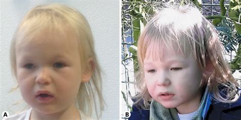 Figure 1 From Angelman Syndrome Affected Individual With A Numerically