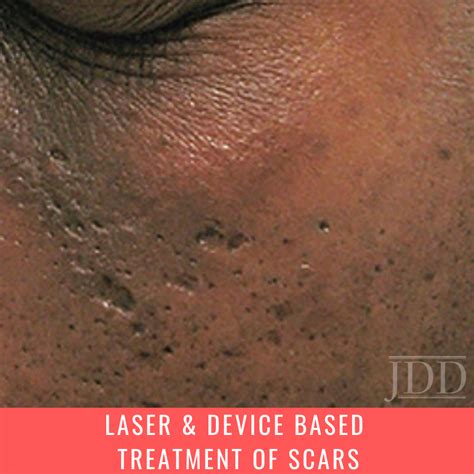 An Update On Laser And Device Based Treatment Of Scars Next Steps In
