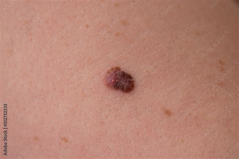 Fotka „close Up Of An Atypical Mole With Two Colours Which Was
