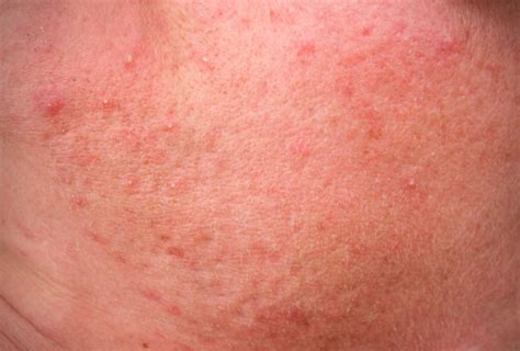 Rosacea The Dos And Donts Of Caring For The Common Skin