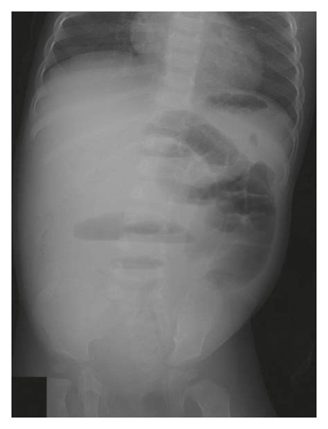 An Abdominal X Ray Scan Demonstrated Multifocal Air Fluid Levels
