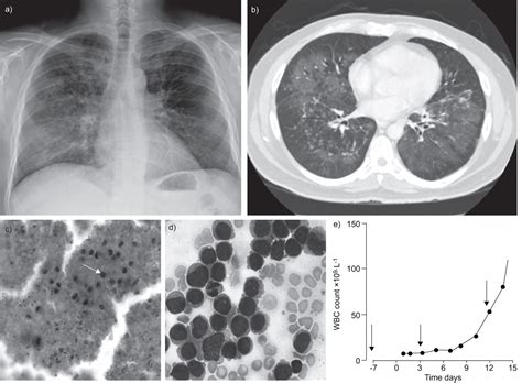 Pneumocystis Pneumonia In An Hiv Negative Patient With No Overt Risk