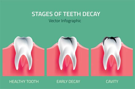 Stages Of Teeth Decay Healthcare Illustrations Creative Market