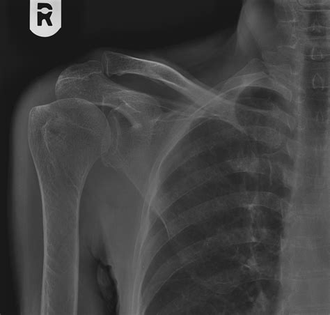 Avulsion Fracture Of The Lesser Tuberosity Of The Humerus Image