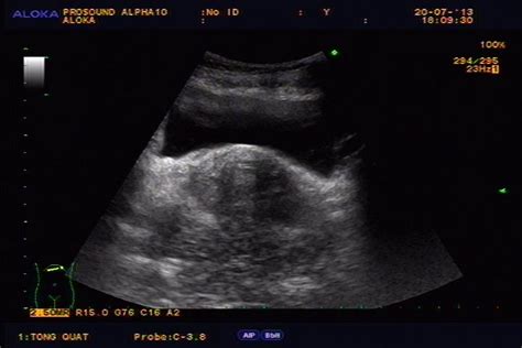 Vietnamese Medic Ultrasound Case 201 Ultrasound First Of