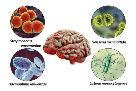 Causes Of Bacterial Meningitis Photograph By Kateryna Konscience Photo