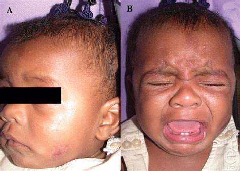 Rapidly Growing Nodular Fasciitis In The Cheek Of An Infant Case