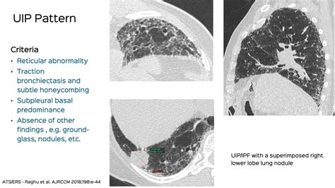 Interstitial Lung Disease Ct Chest Review