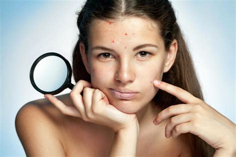 Pimples Due To Cosmetics Acne Cosmetica