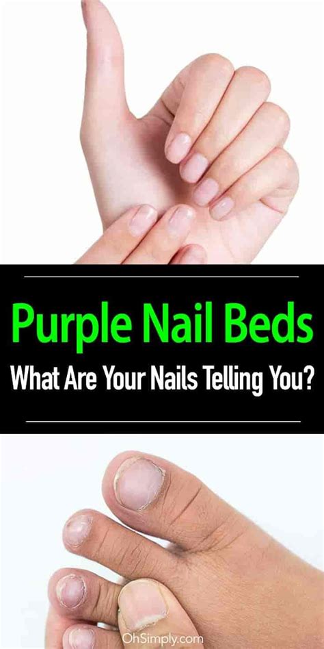 What Are The Possible Causes Of Discolored Or Purple Nail Beds Learn