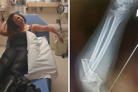 Drunk Girl Has Had So Much She Cant Tell How Broken Her Arm Is Daily