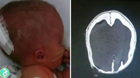 Baby Born Without A Brain Years Later Doctors Discover Something And